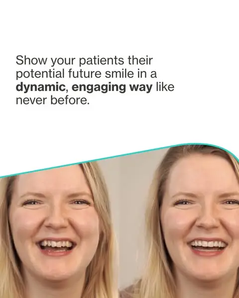 Кадр рекламы iTero Intraoral Scanner